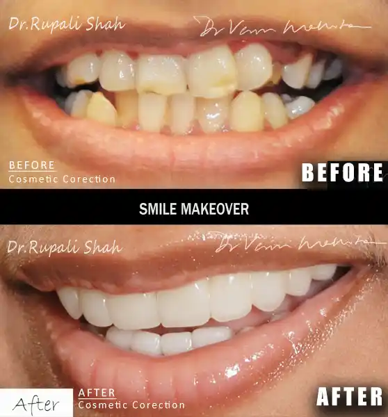 Smile Design Before After Mumbai Patient 2 - Composite Makeover